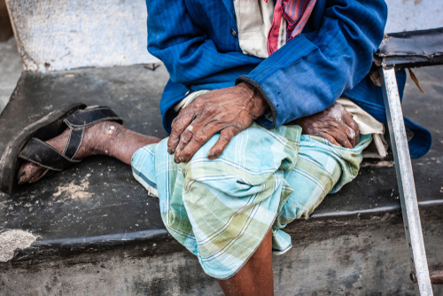INDIA, POOR, LEPROSY
